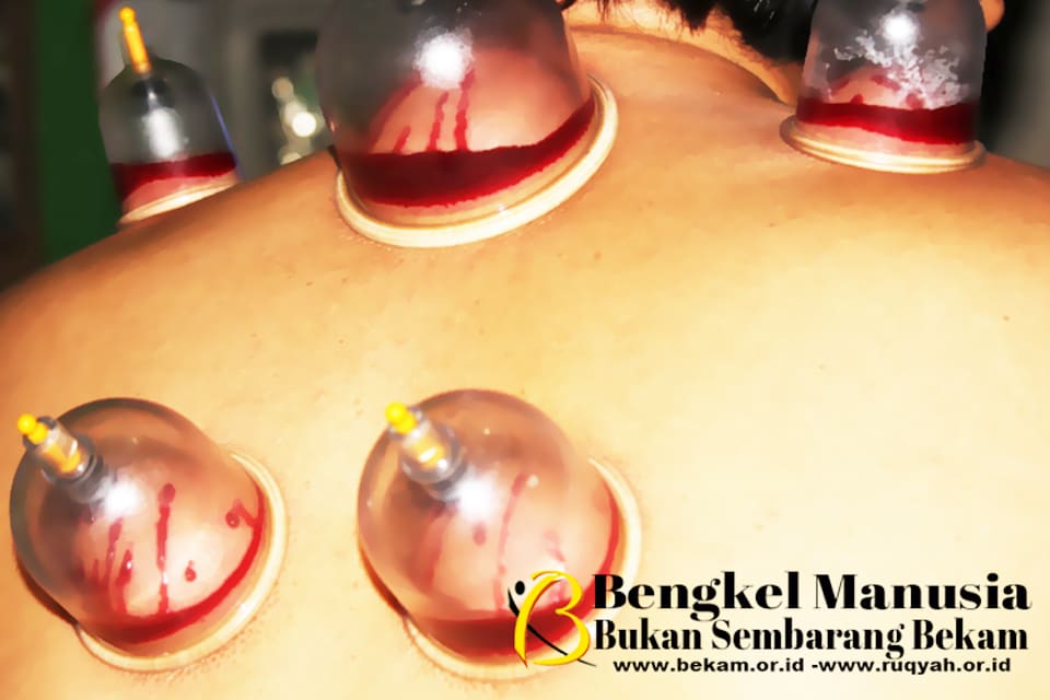 What is Wet Cupping Therapy in Brunei Darussalam, Is Still Important? 