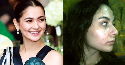 Hania Aamir Struggling with Skin Acne and Red Bumps on her Face