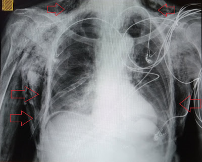 Enfisema subcutaneo, rx imagem, raio x imagem, imagens de raio x, Exame radiologico