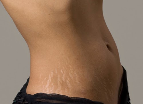 Cara Menghilangkan Stretch Mark