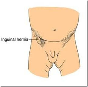 Gejala Penyakit Hernia