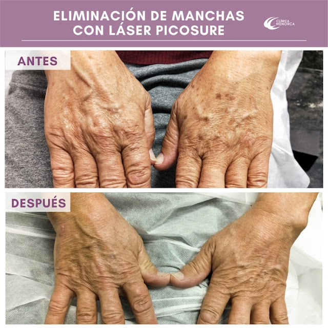 Los mejores tratamientos para la eliminación de las manchas de la piel