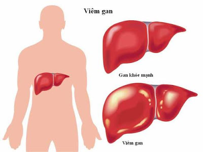 điều trị ung thư gan