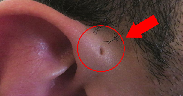 Some People Are Born With Tiny Holes Above Their Ears – And This Is Why???