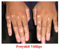 Obat Vitiligo