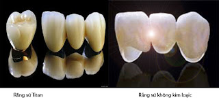 Phục hình cho răng bằng răng sứ Venus