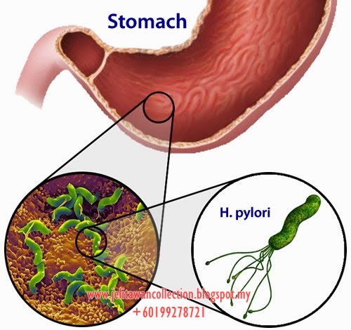 Gastrik: Tanda, Punca dan Rawatannya  Jelitawan Collections
