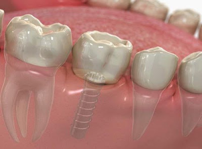 Cấy ghép implant thay cho trồng răng giả