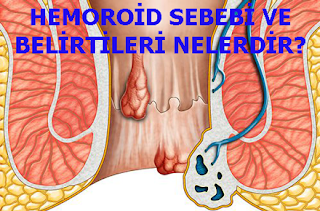 HEMOROİD SEBEBİ VE BELİRTİLERİ NELERDİR?