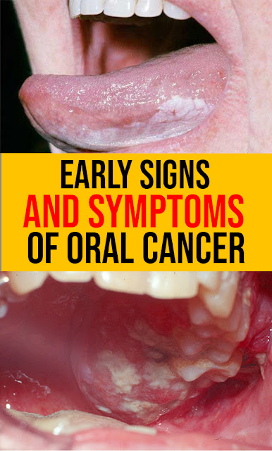 Warning Signs of Oral Cancer: Are You at Risk?