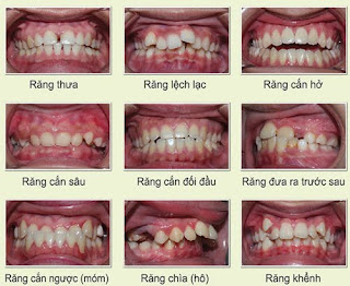 Tổng hợp về răng lệch khớp cắn