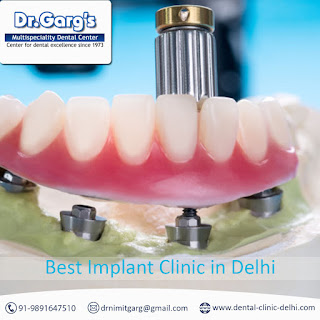 Best Implant Clinic in Delhi