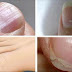 7 Common Nail Conditions Linked to Serious Diseases That You Shouldn’t Ignore!