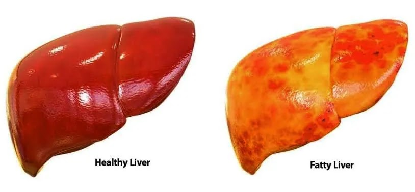 Understanding Fatty Liver: Causes, Cure, Precautions, and Diet Chart.