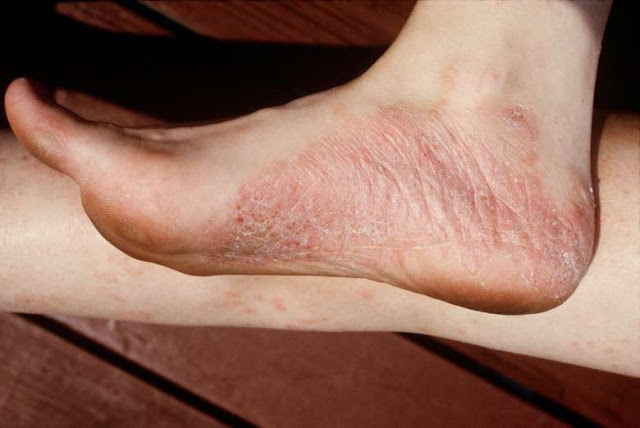 About Diseases of the Feet