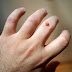 A Closer Look At How To Remove Warts