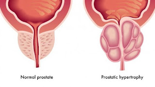 Pengelompokan Kanker Prostat (Pengklasifikasian)