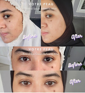 votre-peau-retinol-serum-retinol-eye-cream-before-after-result-bintangmahayana-com