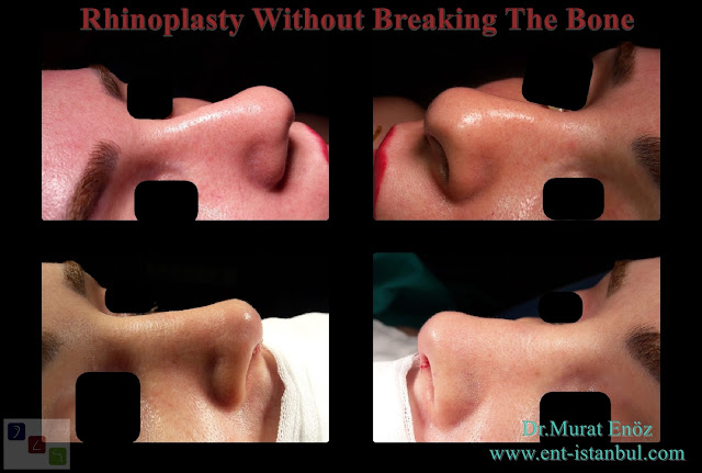 Bruising After Rhinoplasty without bone breaking,Swelling After Nose Job Without Touching The Bone,Nose aesthetic surgery without breaking bone, Nose tip plasty, Nose hump reduction
