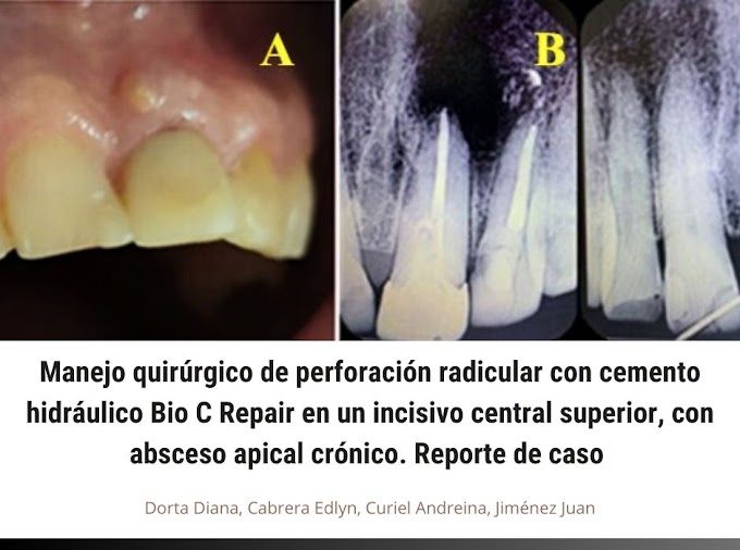 PDF: Manejo quirúrgico de perforación radicular con cemento hidráulico Bio C Repair en un incisivo central superior, con absceso apical crónico. Reporte de caso 