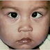 Discovered-Amblyopia (also called lazy eye) is a type of poor vision that usually happens in just 1 eye but less commonly in both eyes.