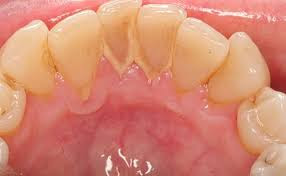 Cạo vôi răng có ảnh hưởng gì không ?