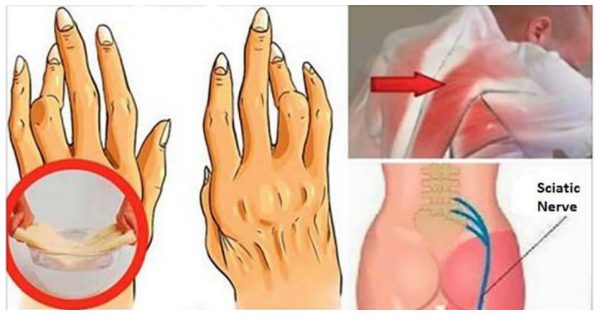 Miracle Oil for Pain Relief Of Your Arthritis And Sciatica