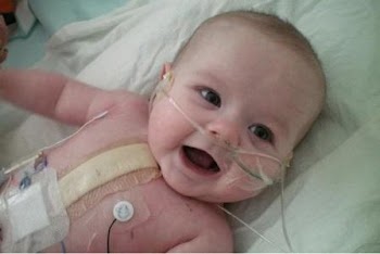 التشوهات الخلقية فى القلب عند الاطفال congenital heart defects
