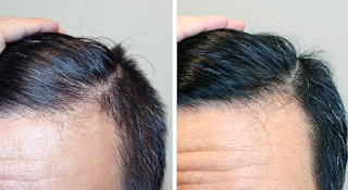 hair loss clinic