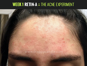 Week 1 on Retin-A :: The Acne Experiment