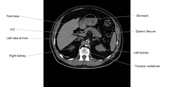 Anatomi CT Scan Abdomen
