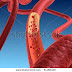 Simple Definition and Description of Arteriosclerosis