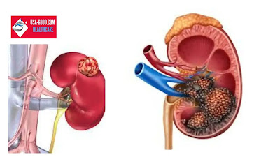 What is Kidney Cancer?