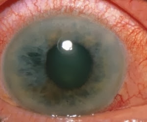 Glaucoma  γλαύκωμα