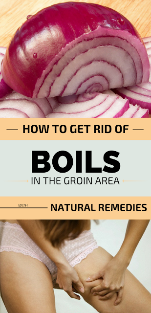 Home Remedies to Get Rid of Boil