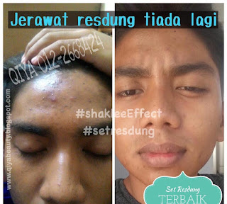 Maksud Jerawat Berdasarkan Kedudukan di Muka, Penyebab Jerawat, Punca Jerawat, Cara Megatasi Jerawat, Cara Hilangkan Jerawat, Supplemen untuk Jerawat, Vitamin untuk Kulit Cantik, Set Kecantikan Shaklee, Petua Kulit Cantik, Rahsia Kulit Cantik, Sustained Release Vita-C Plus Shaklee, Testimoni Sustained Release Vita-C Plus Shaklee, 