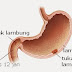 Cara Ampuh Mengobati Tukak Lambung