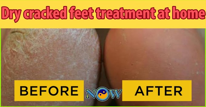 dry cracked feet treatment at home 