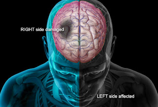 cara Sederhana Cegah Stroke