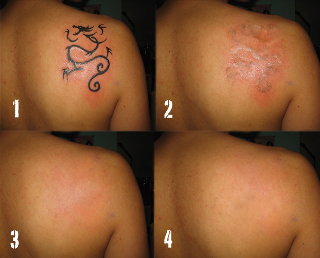 body panting celebrity: Dallas Tattoo Removal