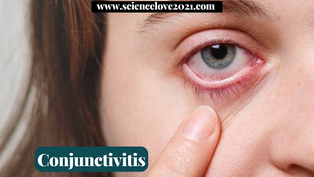 Conjunctivitis: Types, Causes, Symptoms, Treatment, and Prevention Measures