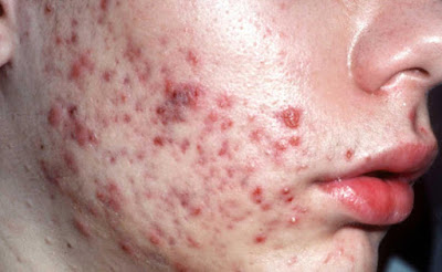 Moderate Acne Vulgaris