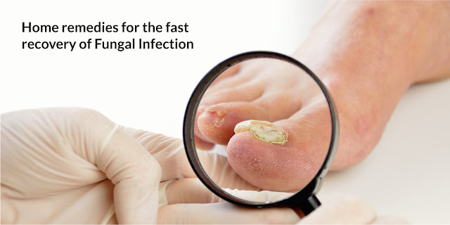 Home remedies for the fast recovery of Fungal Infection
