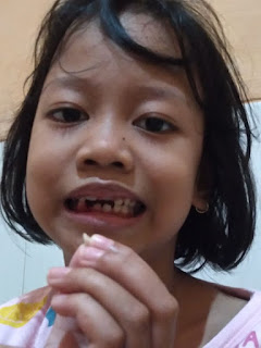 Obat sakit gigi untuk anak yang aman dan nyaman