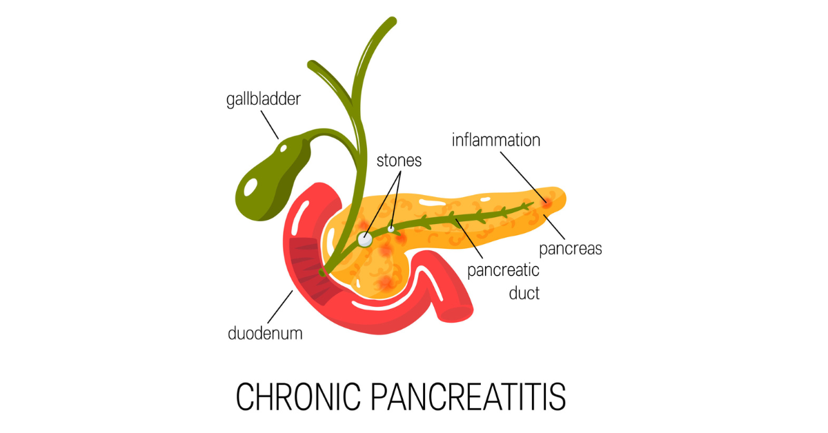 Chronic pancreas