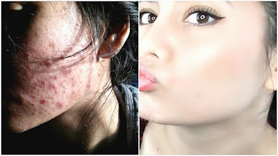 can-glutathione-reduce-or-prevent-pimples-and-acne