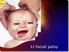 lt facial palsy