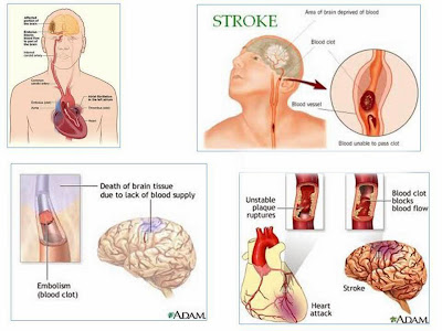 Faktor Pemicu Penyakit Stroke