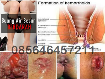 Obat Salep Pengempes Ambeien Luar