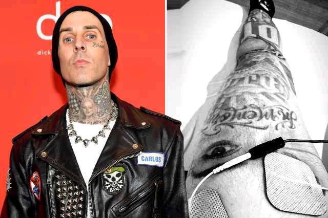 Travis Barker suffers brutal leg injury one day before marathon but vows he’s ‘still running’ race